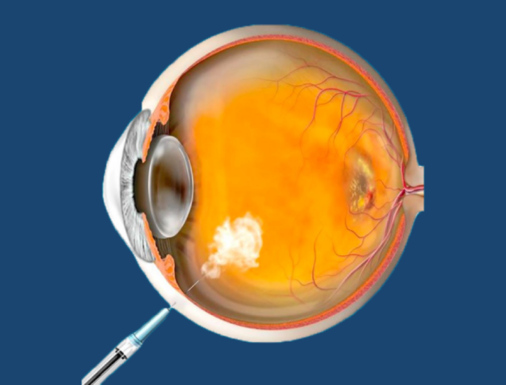 Imagem injecao intravitrea